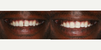 Dental Bonding before and after photo