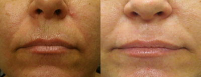 Dermal Fillers before and after photo