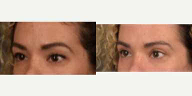 Eyelid Surgery before and after photo