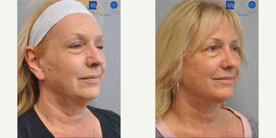 Facelift before and after photo