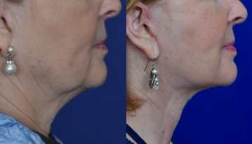 Neck Lift before and after photo