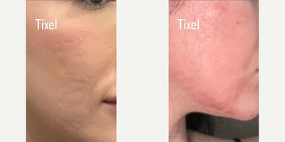 Skin Rejuvenation before and after photo