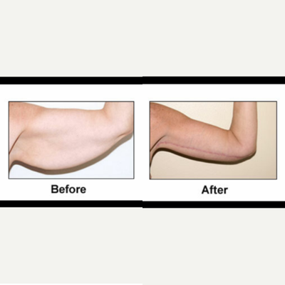 Arm Lift before and after photo