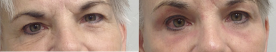 Eyelid Surgery before and after photo