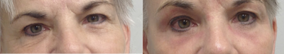 Eyelid Surgery before and after photo