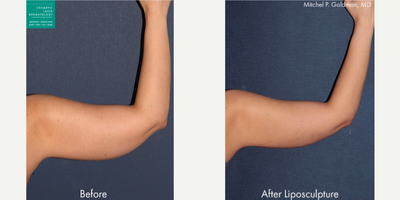 Liposculpture before and after photo