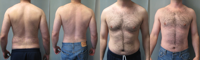 Liposuction before and after photo