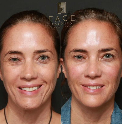 Belotero before and after photo