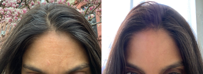 Botox before and after photo