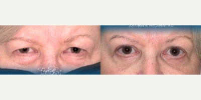 Brow Lift before and after photo