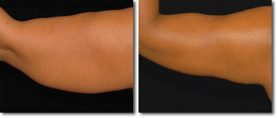 Laser Liposuction before and after photo