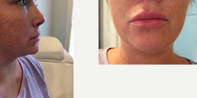 Lip Fillers before and after photo