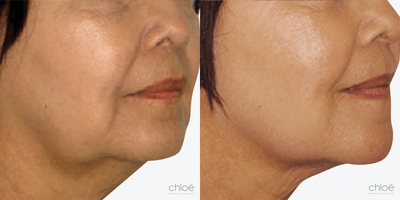 Venus Legacy before and after photo