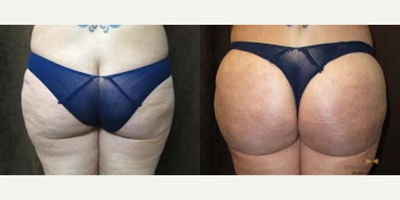 Brazilian Butt Lift before and after photo