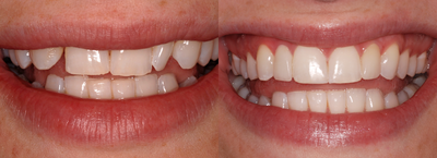 Invisalign before and after photo