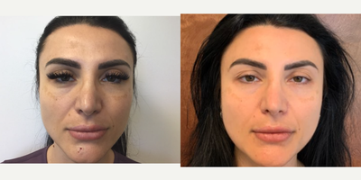 Microneedling before and after photo