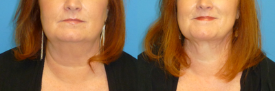 Neck Lift before and after photo