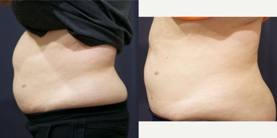 SculpSure before and after photo