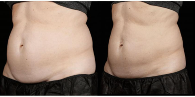 SculpSure before and after photo