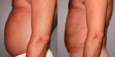 Tummy Tuck before and after photo