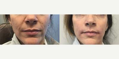 Bellafill before and after photo