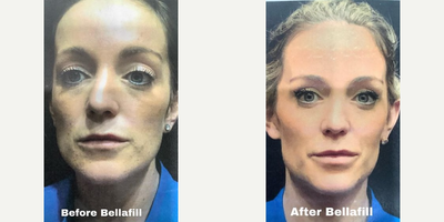 Bellafill before and after photo