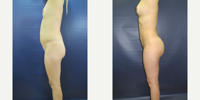 Brazilian Butt Lift before and after photo
