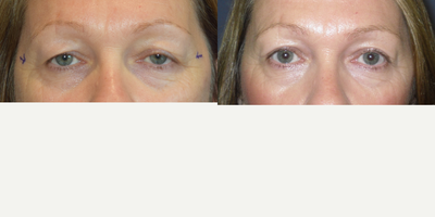Eyelid Surgery before and after photo