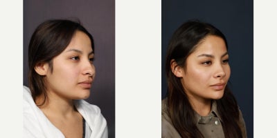 Rhinoplasty before and after photo
