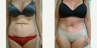 Tummy Tuck before and after photo