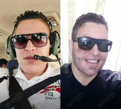 Beard Transplant before and after photo