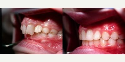 Braces before and after photo