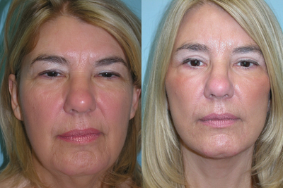 Facelift before and after photo