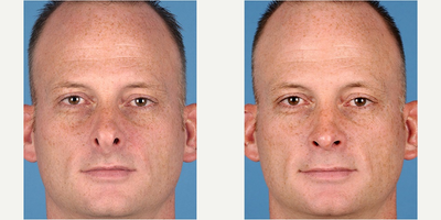 Rhinoplasty before and after photo