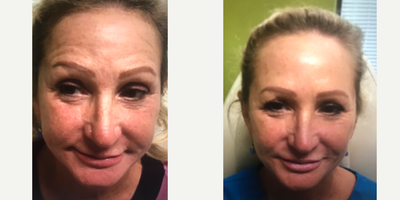 Xeomin before and after photo