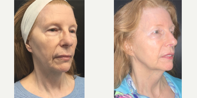 Botox before and after photo