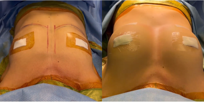 Breast Augmentation before and after photo