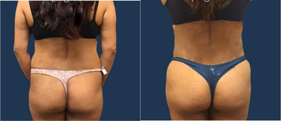 Liposuction before and after photo