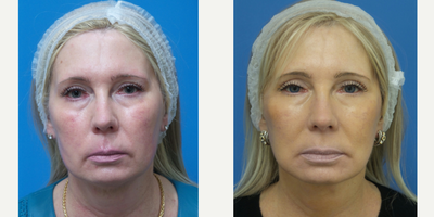 Neck Lift before and after photo
