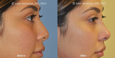 Nonsurgical Nose Job before and after photo