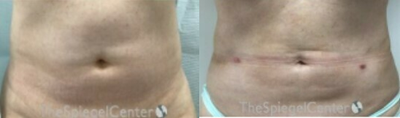 BodyTite before and after photo