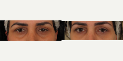 Brow Lift before and after photo