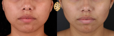 Buccal Fat Removal before and after photo