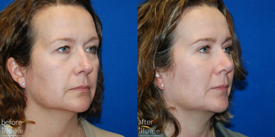 Eyelid Surgery before and after photo