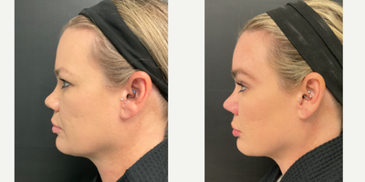 Eyelid Surgery before and after photo