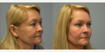 Eyelid Surgery before and after photo