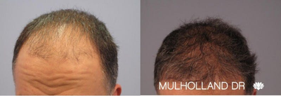 Hair Transplant before and after photo
