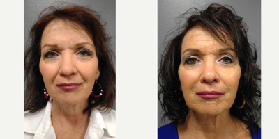 Juvederm before and after photo