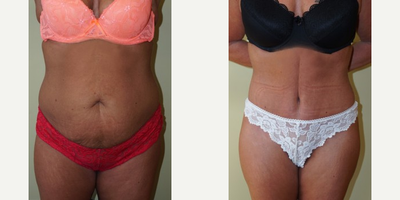 Liposuction before and after photo