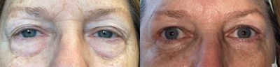 Eyelid Surgery before and after photo